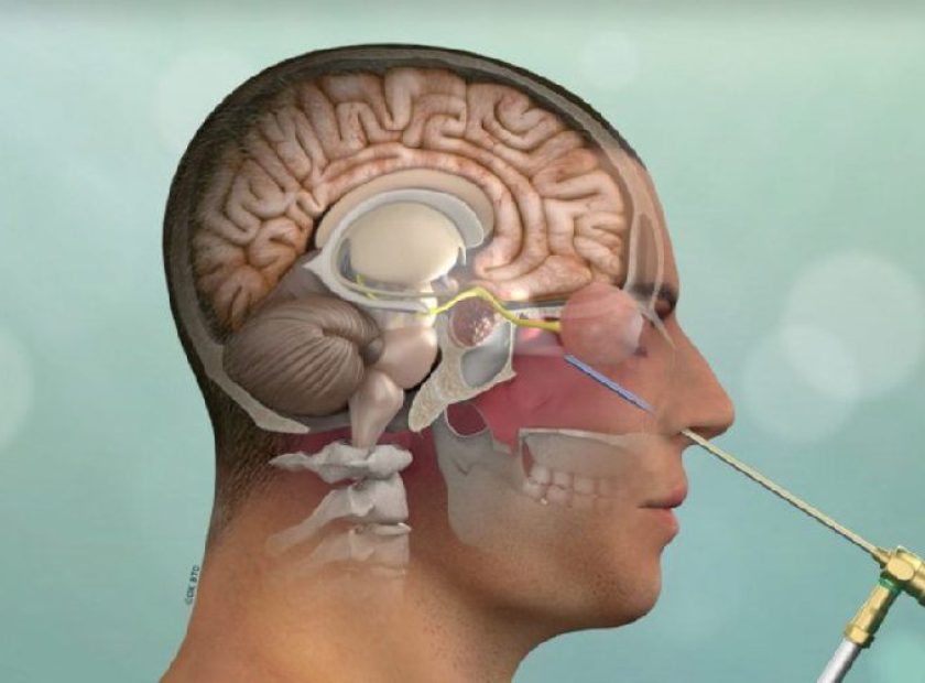 علائم تومور قاعده جمجمه چیست؟
